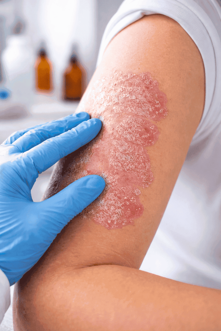 Псориаз простыми словами — лечение нафталановой нефтью и санаторная терапия